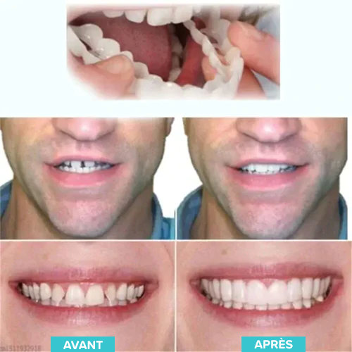 Prothèses ajustables à clipser